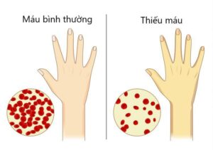 thiu mau