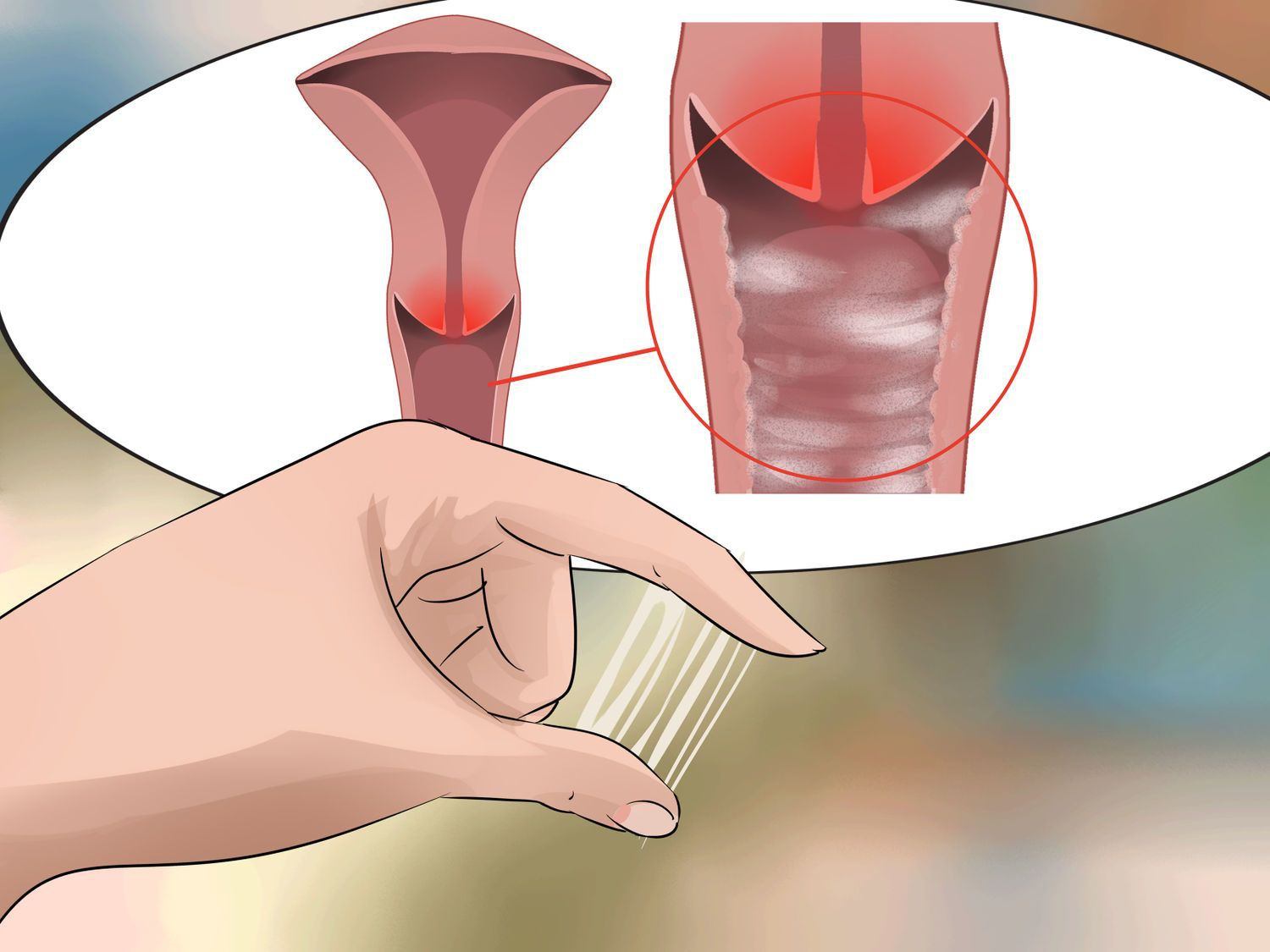 Nguyên nhân viêm nhiễm phụ khoa khi mang thai